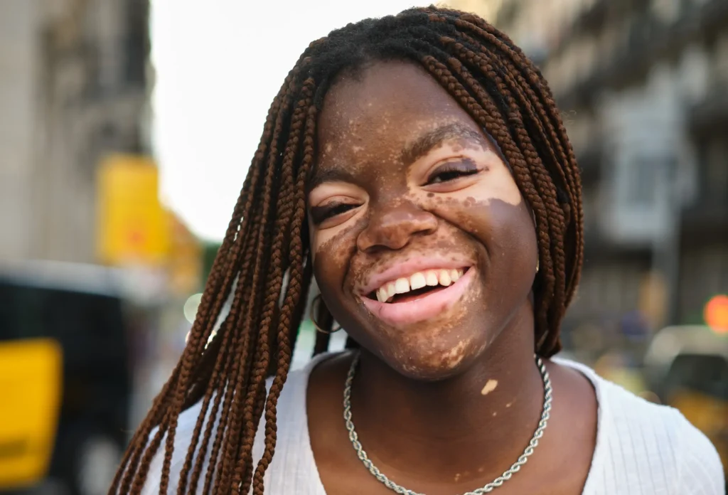 Traitement du vitiligo
